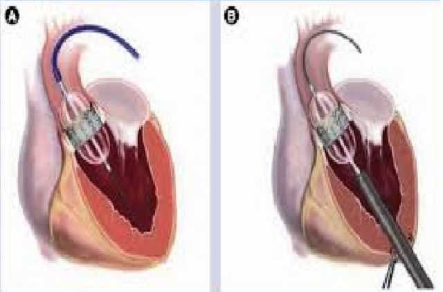 Транскатетерный аортальный сердечный клапан